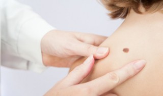 胎记是怎样得来的 胎记是如何形成