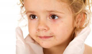 有什么办法可以去痘印吗 有什么办法可以去痘印吗女生