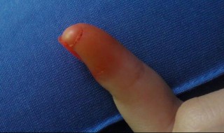 碘酒怎么清洗（碘酒怎么清洗餐具）