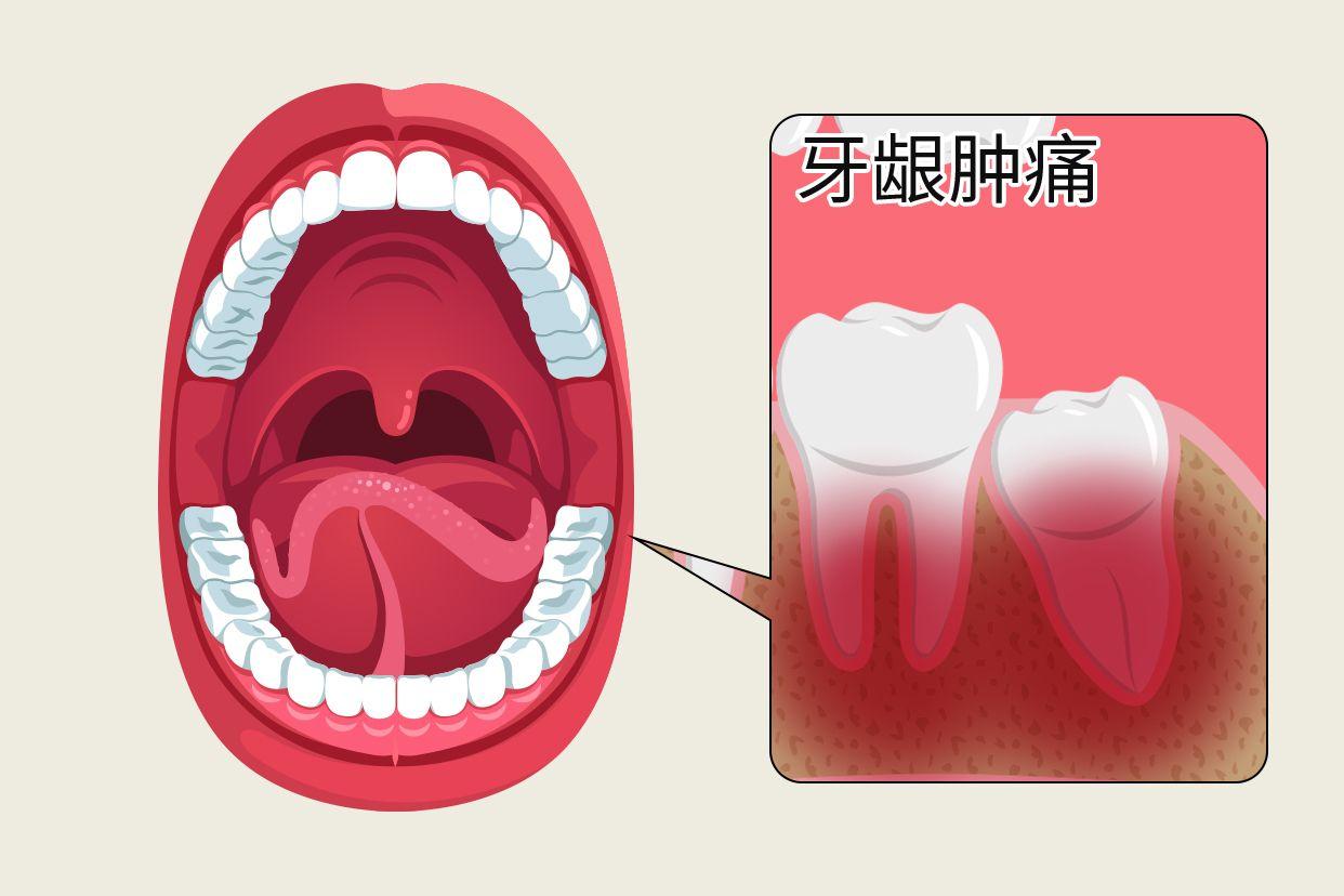 最里面的牙龈肿痛图片 最里面大牙牙龈肿痛图片