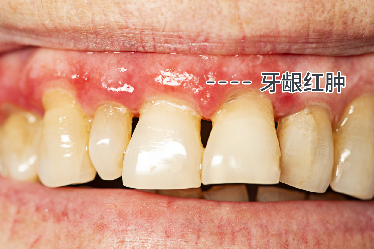 牙周炎牙龈红肿的图片 牙周炎牙龈红肿的图片大全
