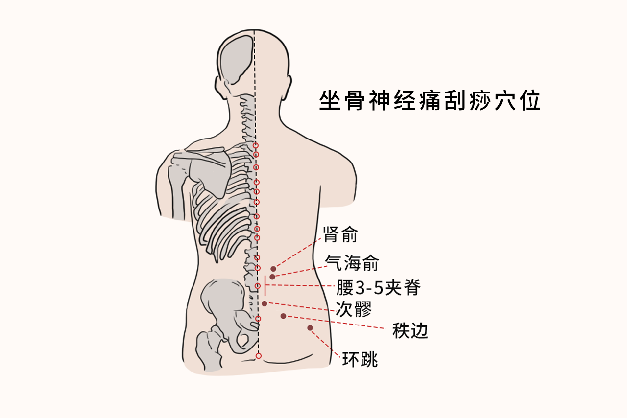 坐骨神经刮痧的方法示意图（坐骨神经刮痧部位图片）