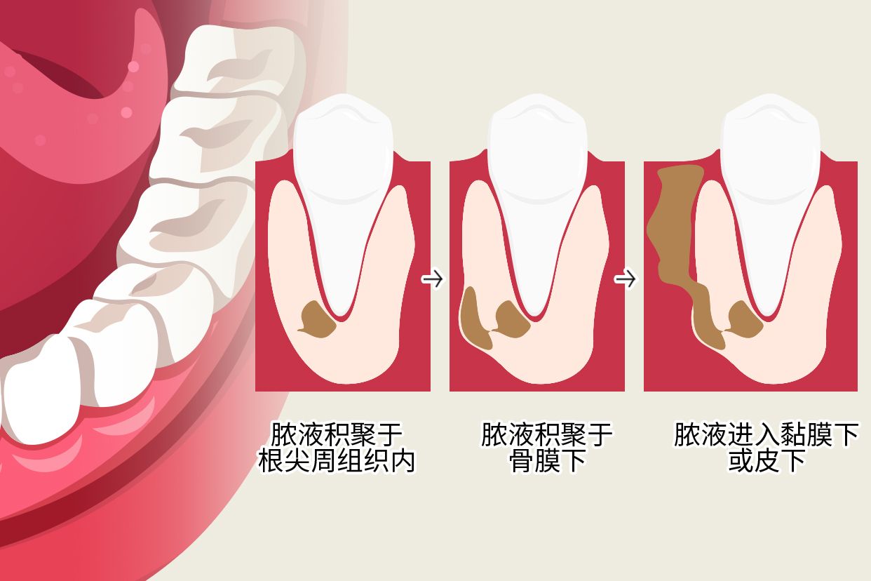 根尖周炎图片全景牙图（牙龈根尖周炎图片）