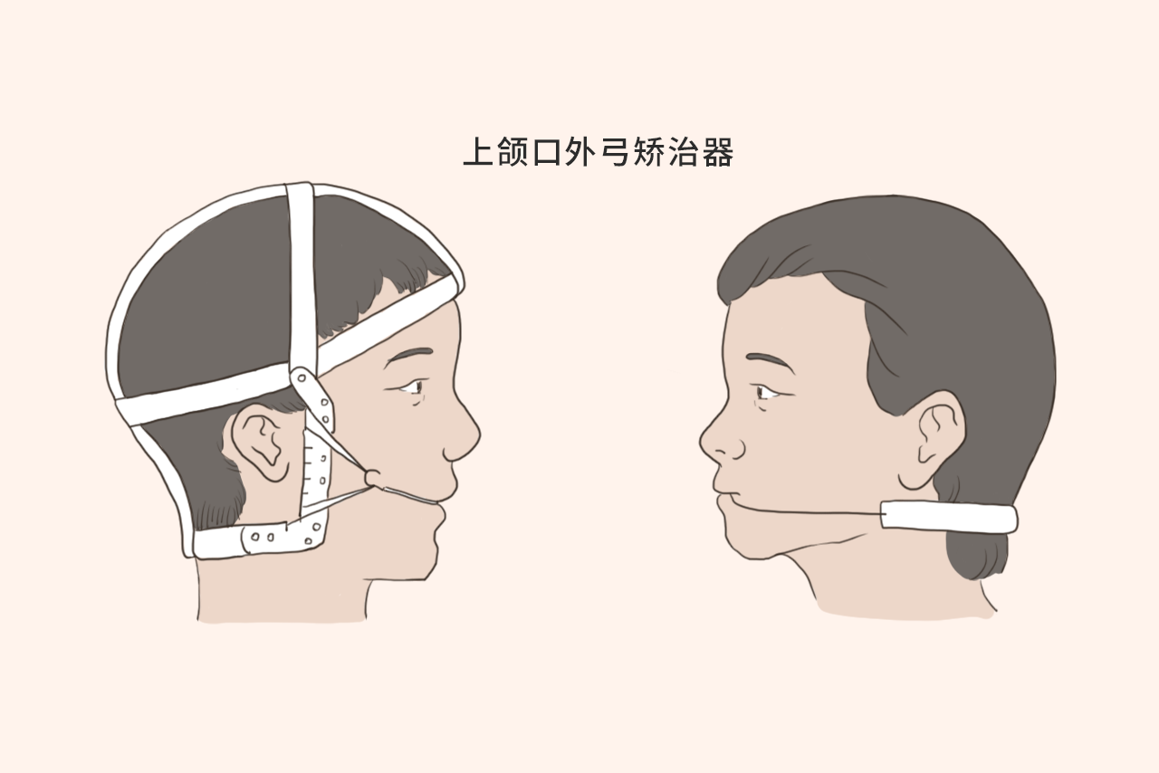 上颌口外弓矫治器图片（下颌唇弓矫治器图片）