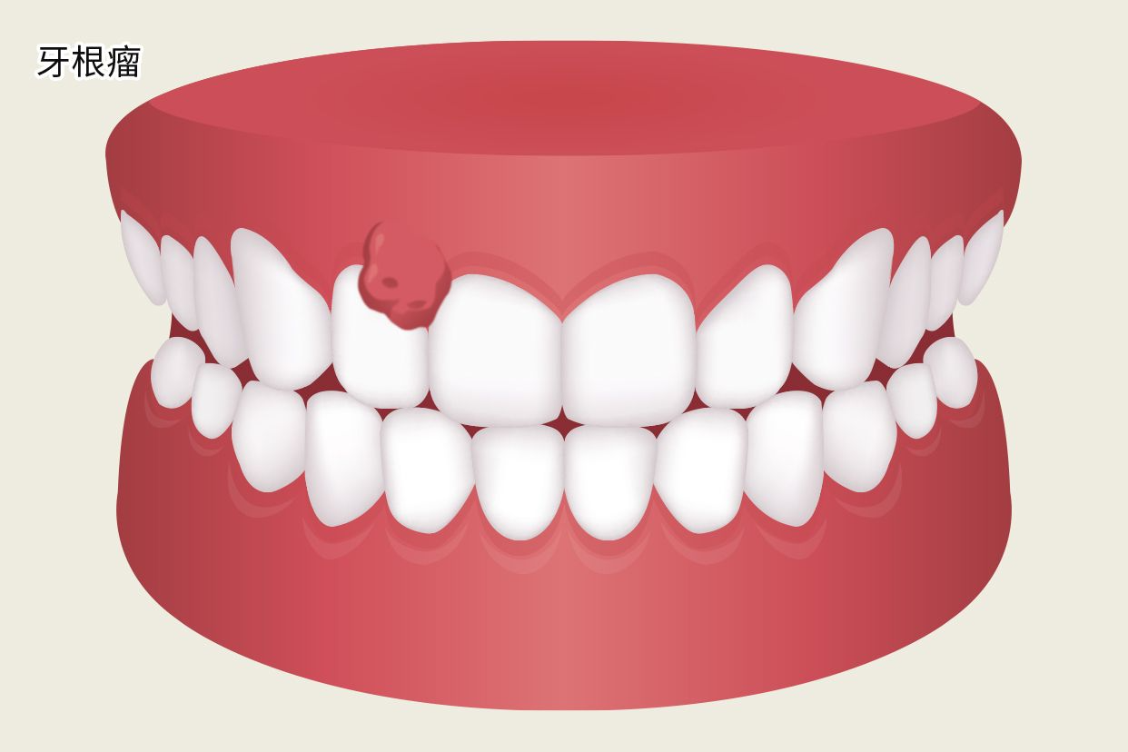 牙根瘤照片（牙根癌症状图片）