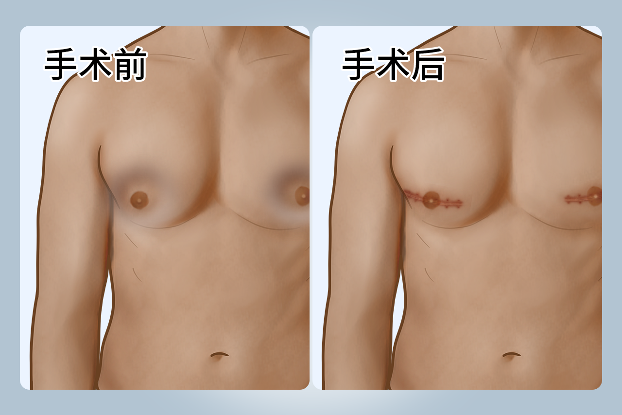 男性乳房手术后凹陷填充图片（男性乳房发育手术后凹陷）