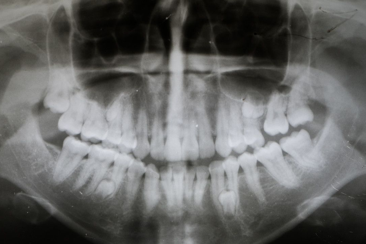 牙齿拥挤x光图（牙齿X光图）