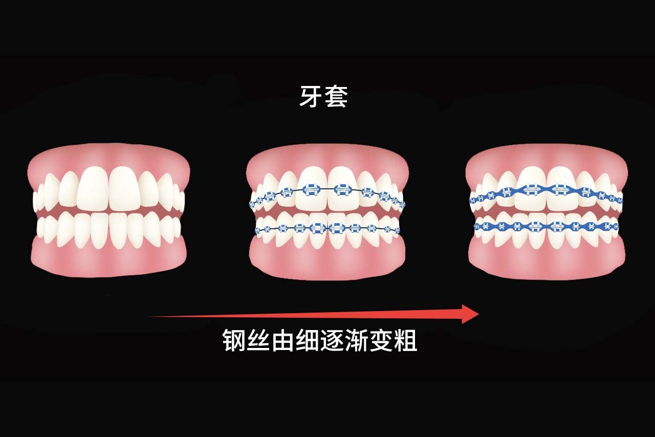 牙套换钢丝粗细顺序图片（牙套换钢丝粗细顺序图片对比）