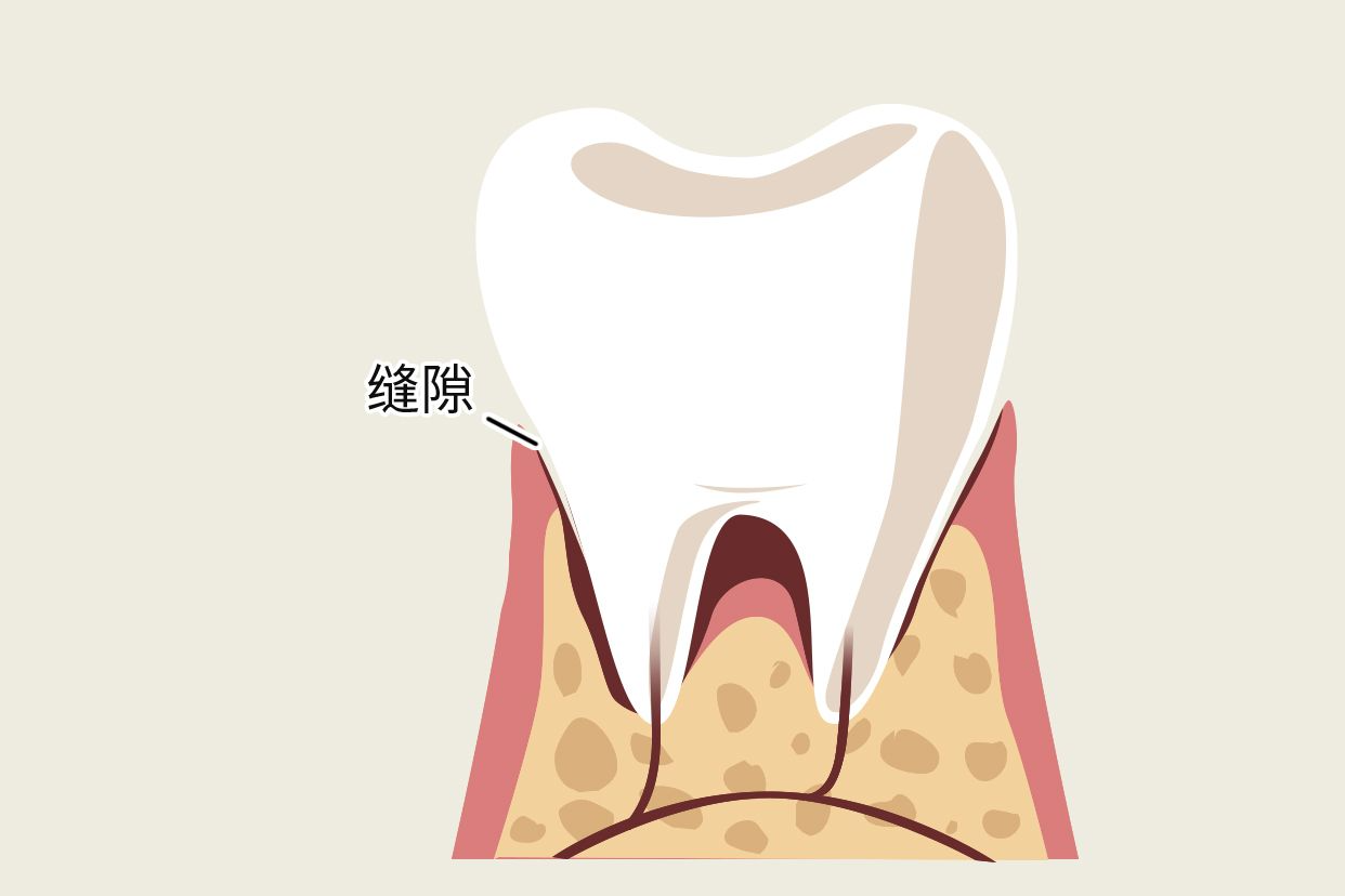 牙冠和牙龈有缝隙图（牙齿和牙龈有缝隙图片）