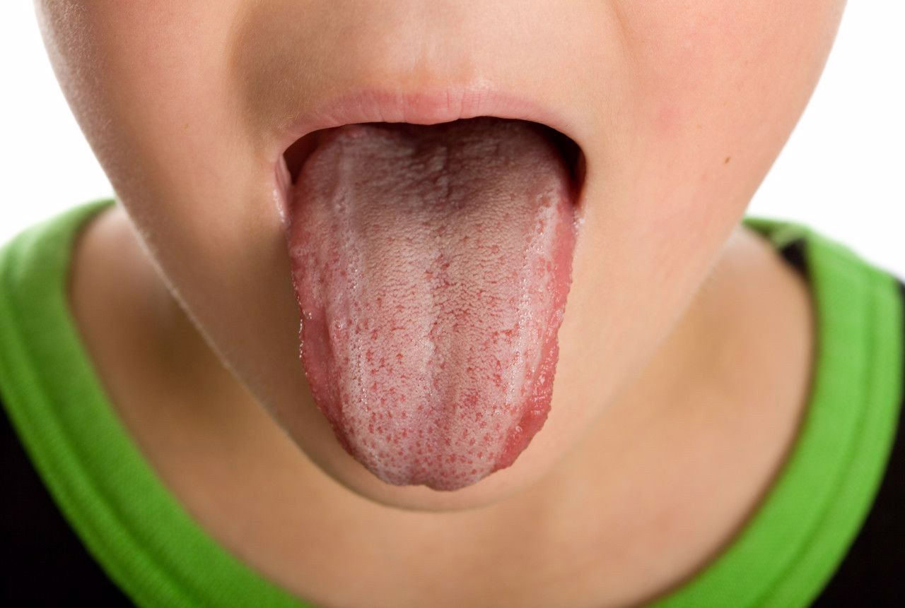 舌头上两边两条竖线图片（舌头中间两条竖线）