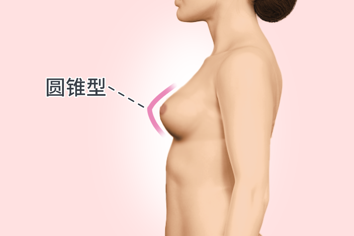 圆锥型胸型图片（圆锥状胸型）