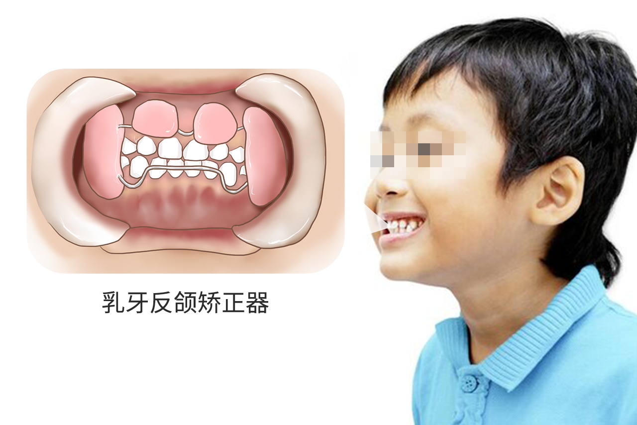 乳牙反颌矫正器图片（牙齿反颌矫正器）