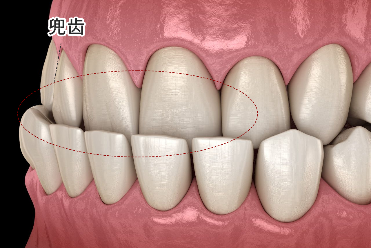 兜齿严重的照片 兜兜齿的照片