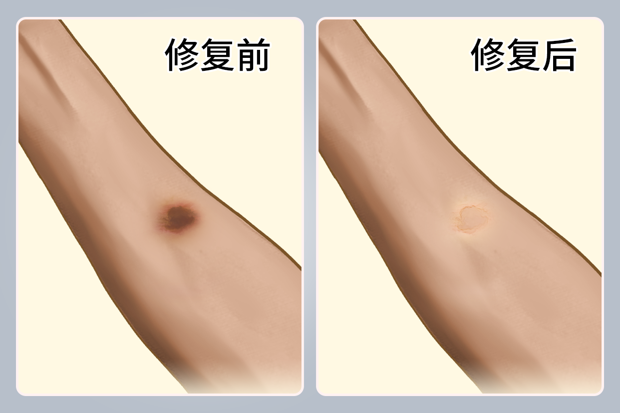 烟头烫伤疤痕激光治疗前后图片 烟头烫伤疤痕激光治疗前后图片大全