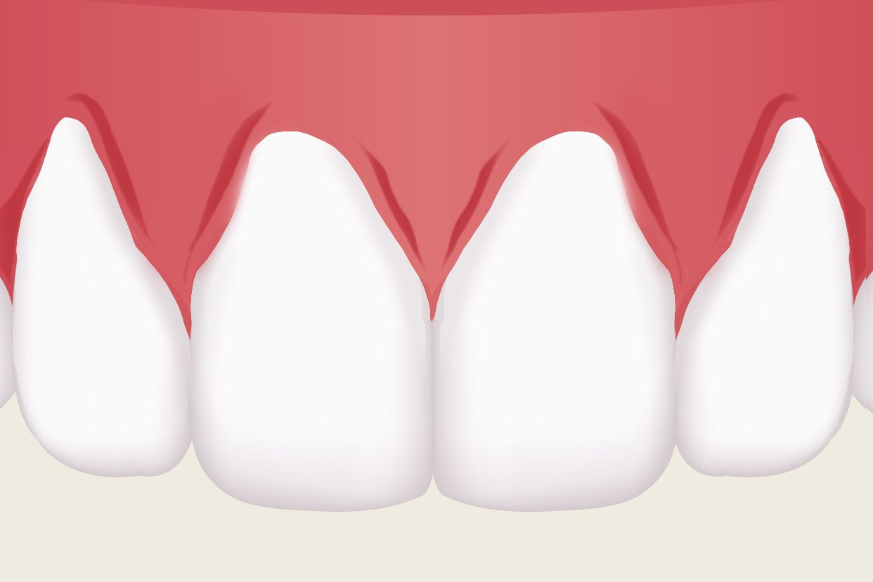 上排侧面牙牙龈萎缩图（下排牙牙龈萎缩图）