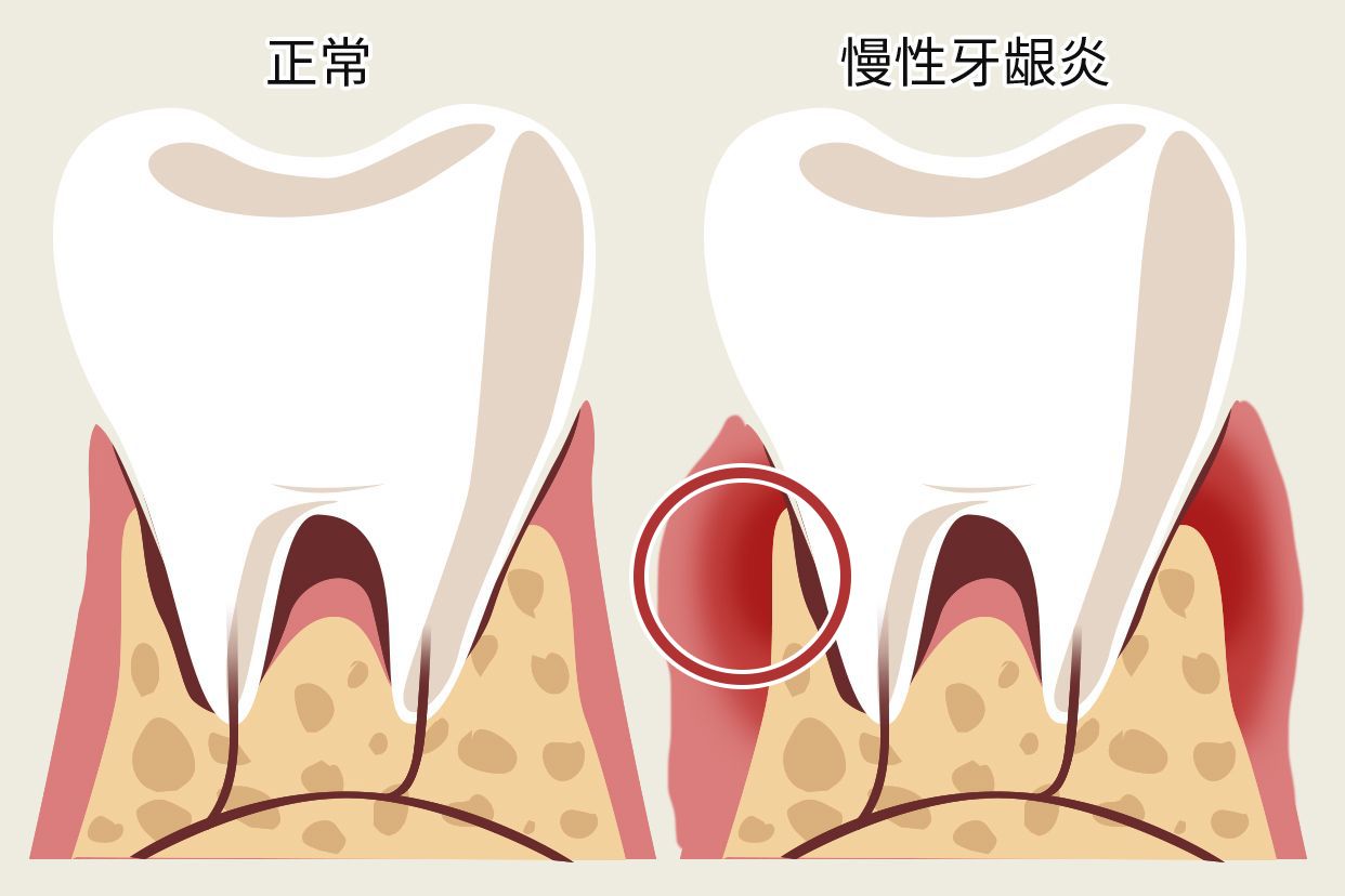 慢性牙龈炎图片（慢性牙龈炎图片及症状）