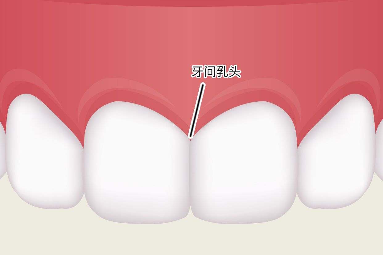 牙龈乳头图片（乳牙门牙的图片）