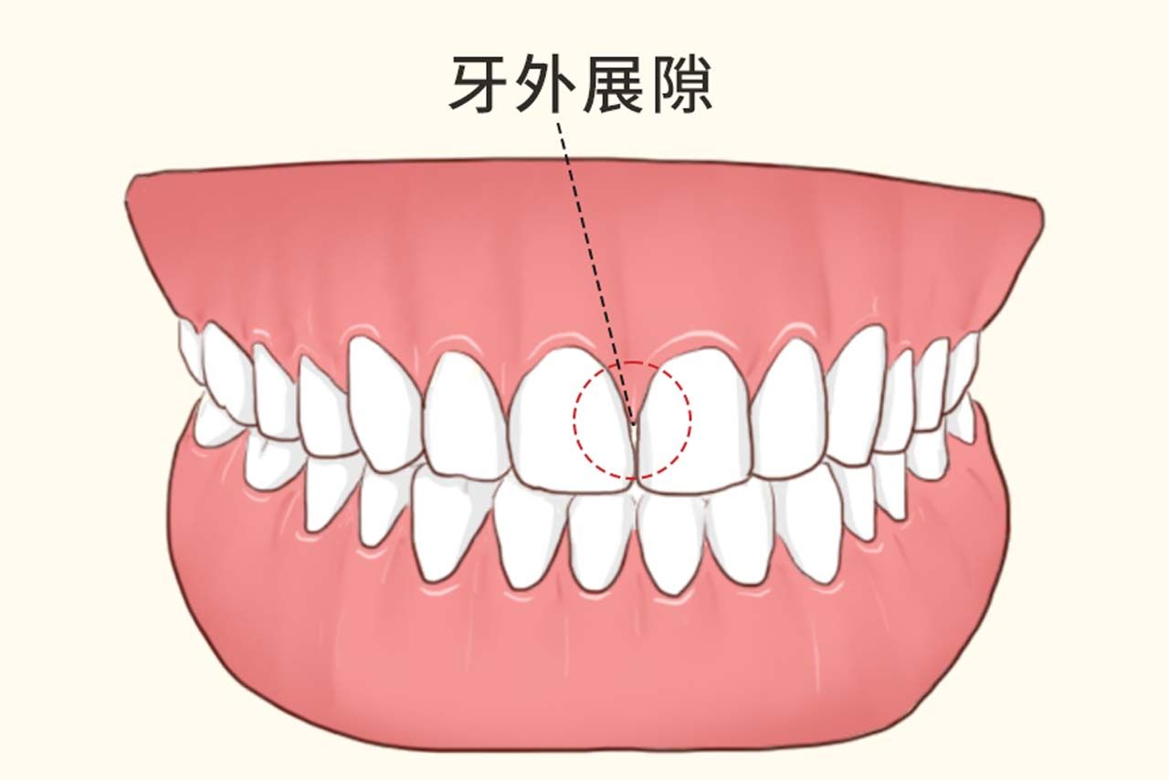 牙外展隙图解（牙齿外展隙解剖图片）