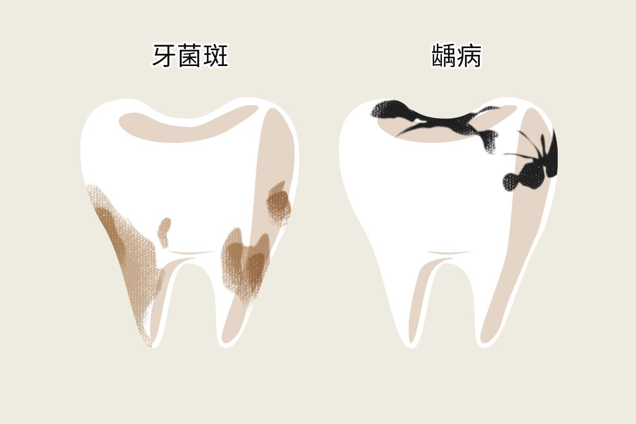 牙垢和蛀牙的区别图片（牙垢和蛀牙怎么区分）