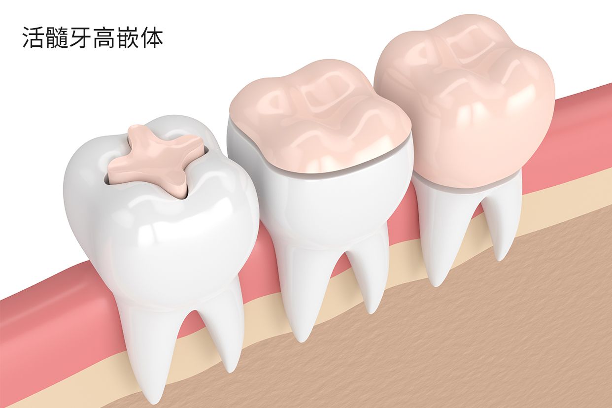 活髓牙高嵌体图片（活髓牙 嵌体）
