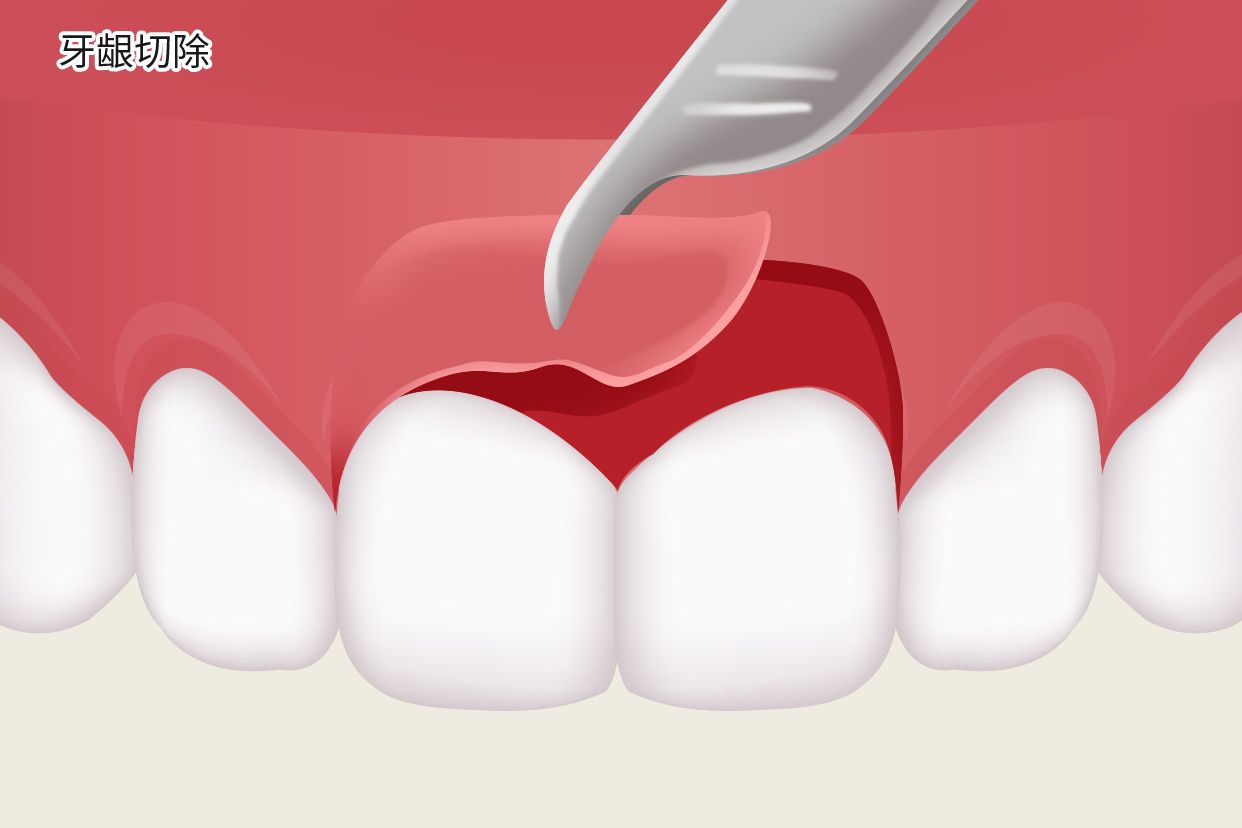 牙龈切掉能长吗图片