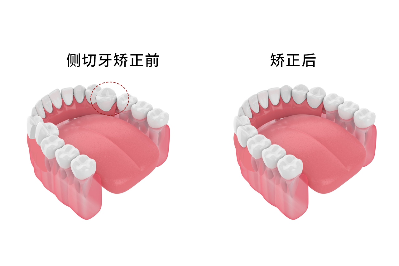 侧切牙小又尖纠正图片