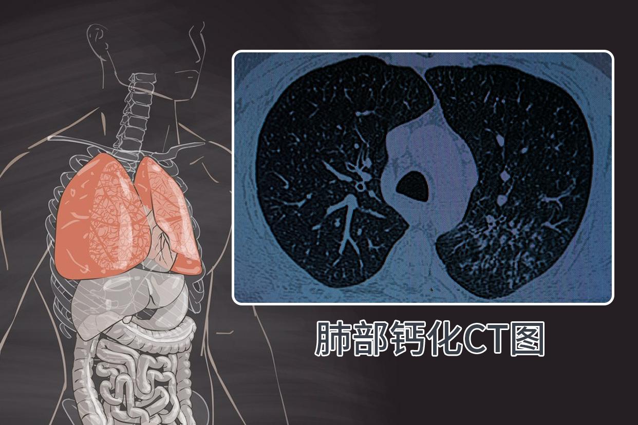 肺部钙化ct图像啥样的 肺部钙化ct图像啥样的图片