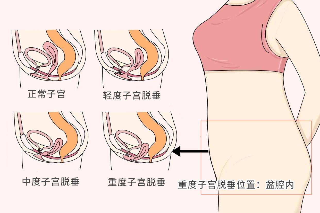 宫颈上吊严重位置在哪呢图片 宫颈上吊有什么影响