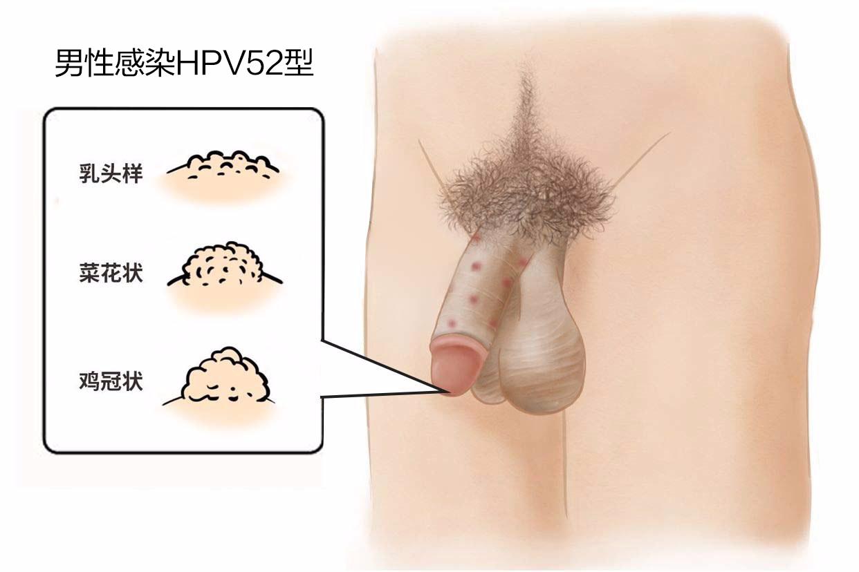 hpv52疣体长什么样（hpv52有疣体会终生携带吗）