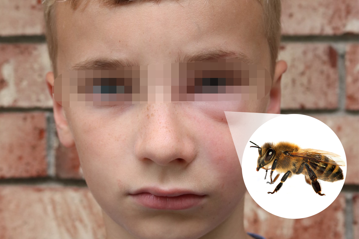 小孩被蜜蜂蛰了肿图片（小孩被蜜蜂蛰了肿了怎么处理）