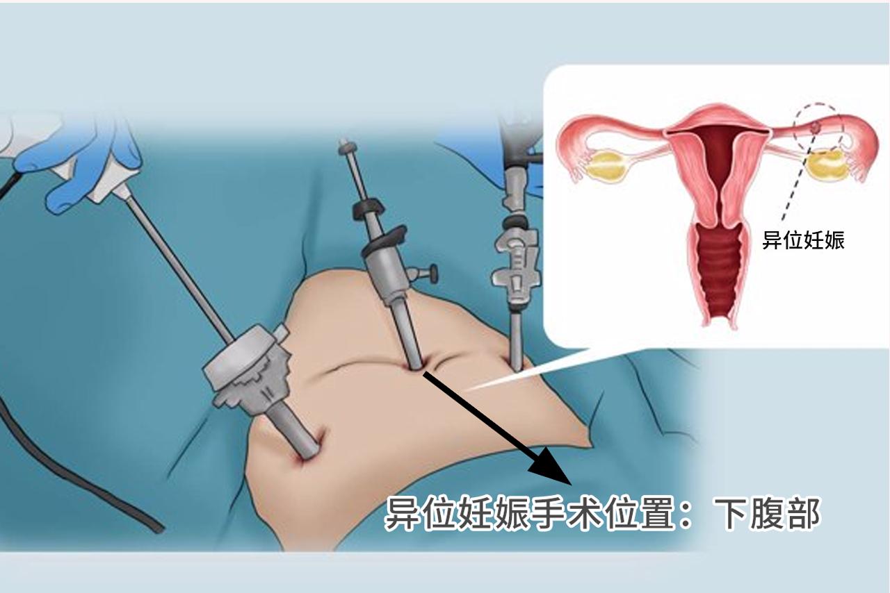 宫外孕手术在哪里开刀图 宫外孕手术在哪里开刀图片大全