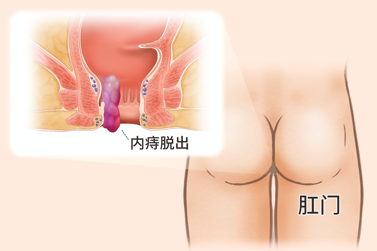 内痔痔核脱出的照片（内痔核脱出的症状）