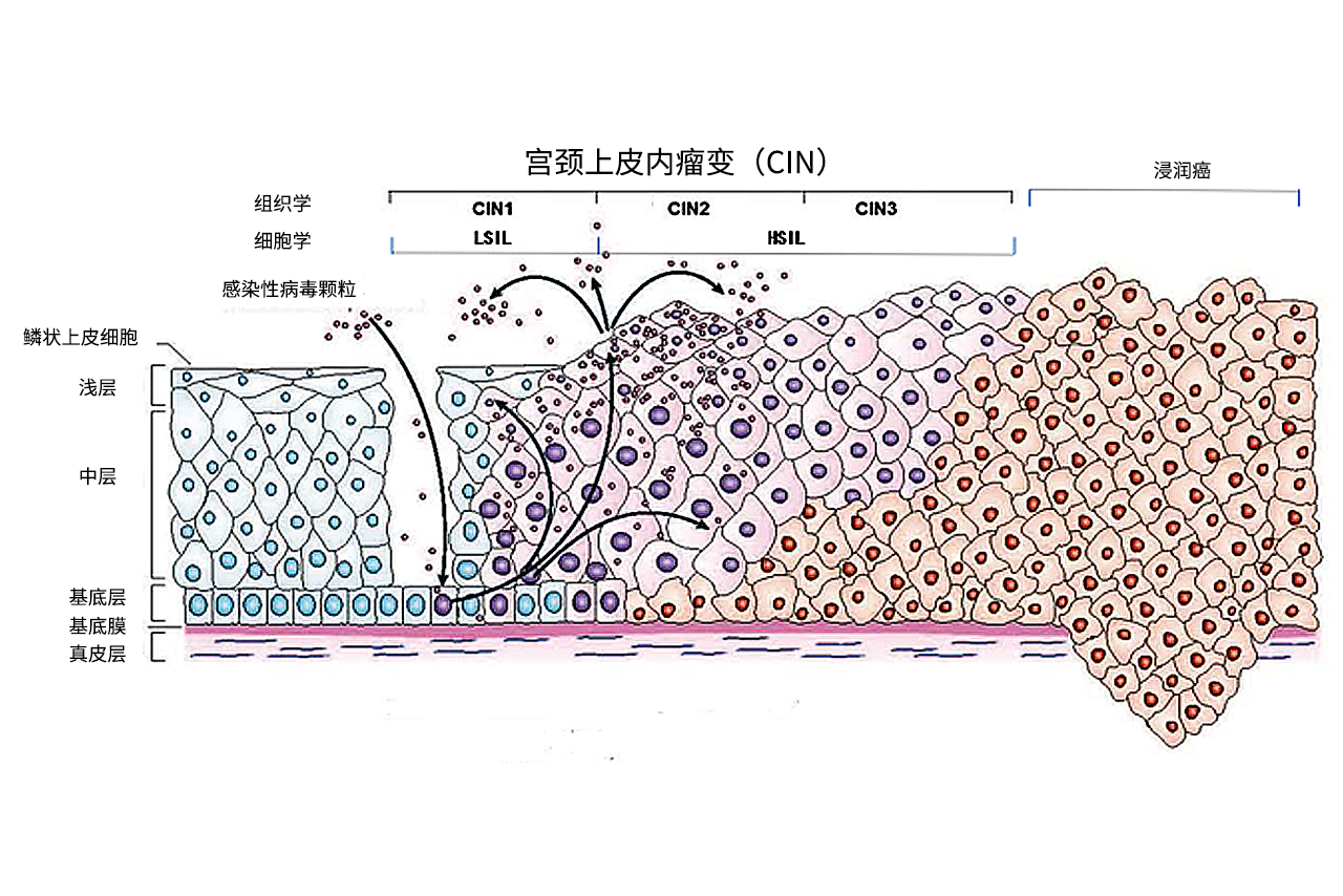 宫颈cin分级图片（宫颈cin的分级）