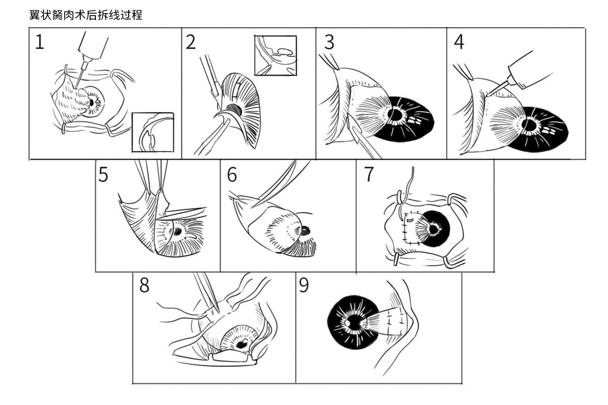 翼状胬肉术后拆线过程图 翼状胬肉术后拆线步骤