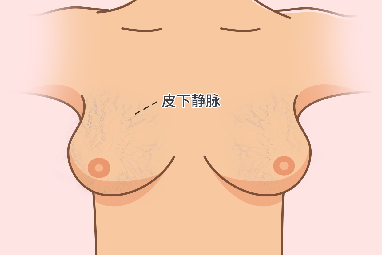 乳房皮下静脉图片 乳房下静脉明显