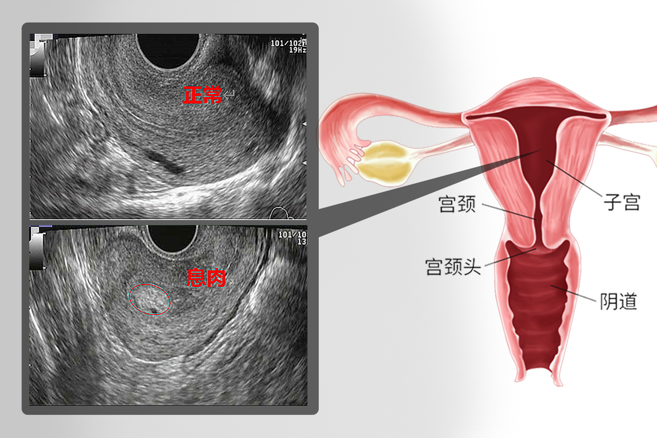 子宫息肉的b超图像 子宫息肉b超报告是什么样