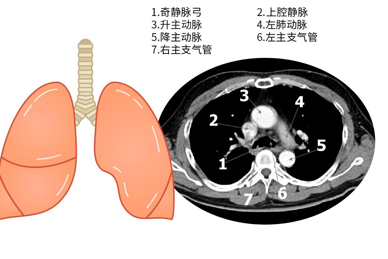 主动脉肺动脉窗图片（主动脉肺动脉窗的临床意义）