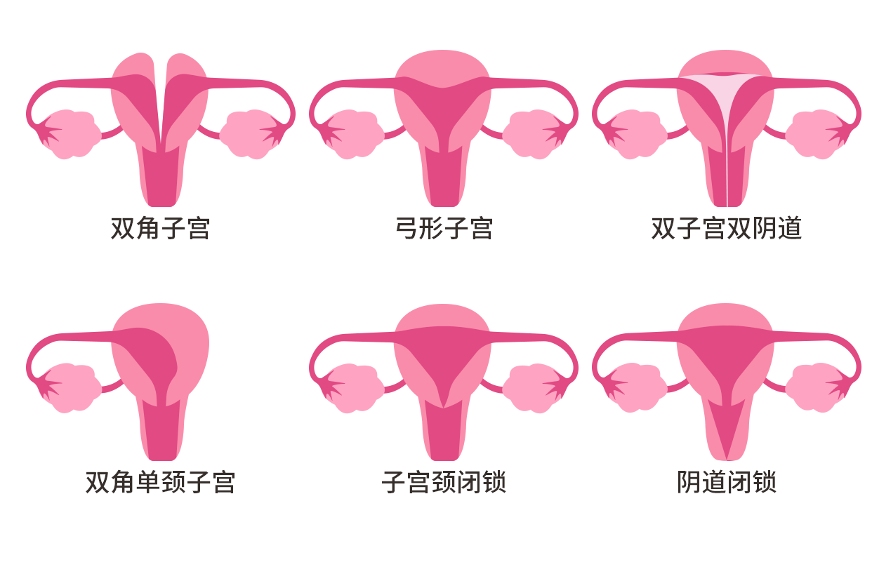 残角子宫示意图（残角子宫可以正常怀孕吗）