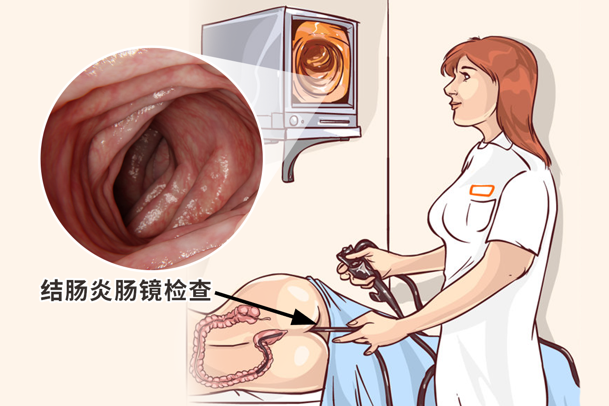 结肠炎肠镜检查图片 结肠炎肠镜检查图片真实