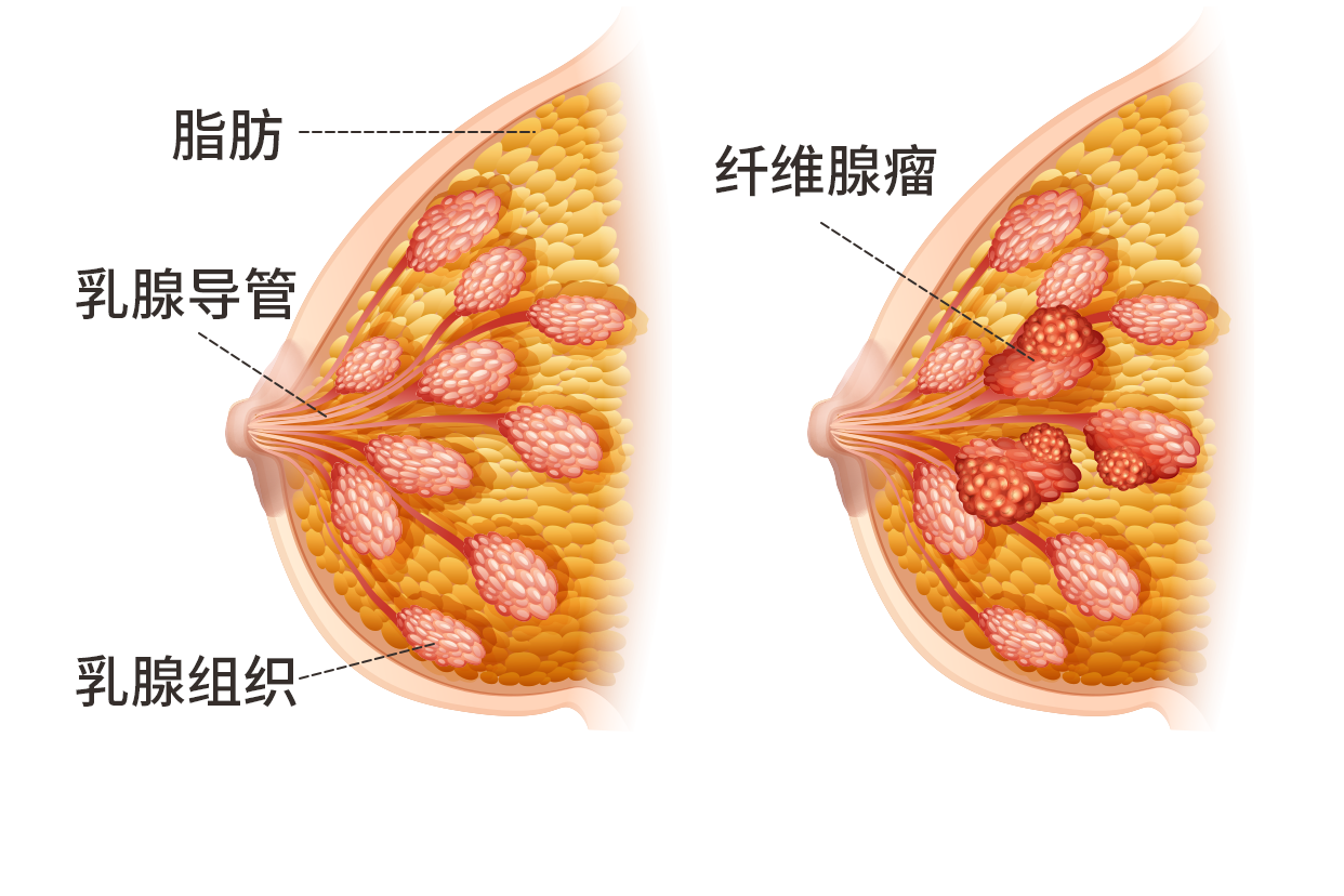 乳房上方纤维瘤图片（乳房上方纤维瘤图片高清）