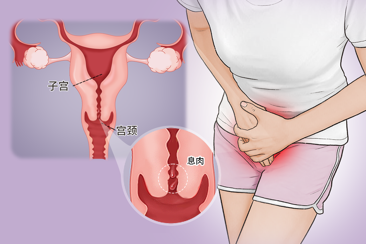 宫颈旁边有息肉图片 宫颈旁边有块肉是什么