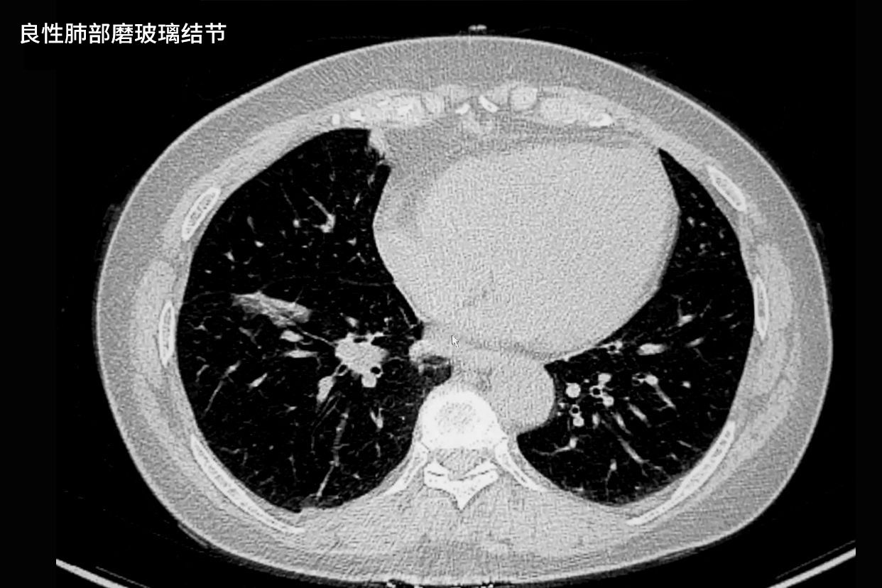 良性肺部磨玻璃结节影像图 肺良性磨玻璃ct表现