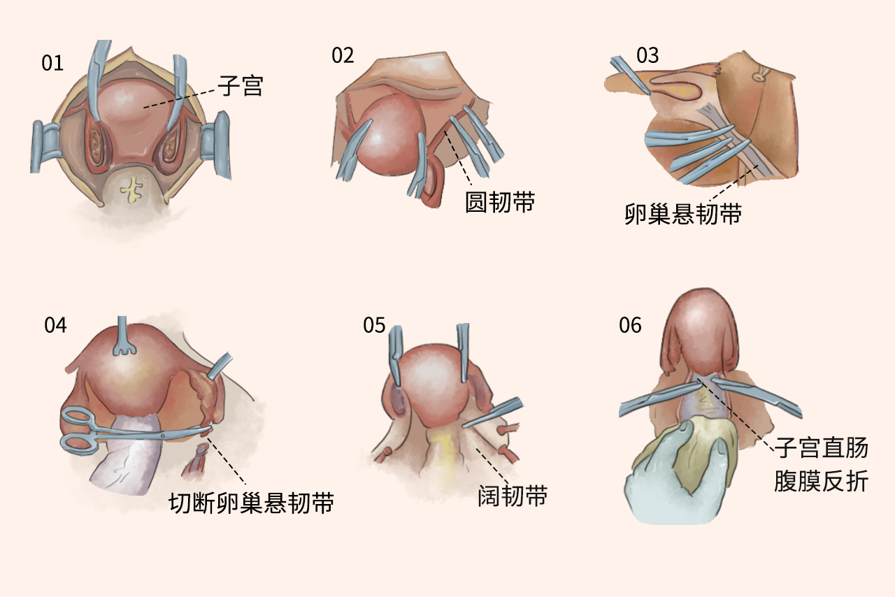 子宫卵巢的切除手术示意图（子宫卵巢的切除手术示意图图片）
