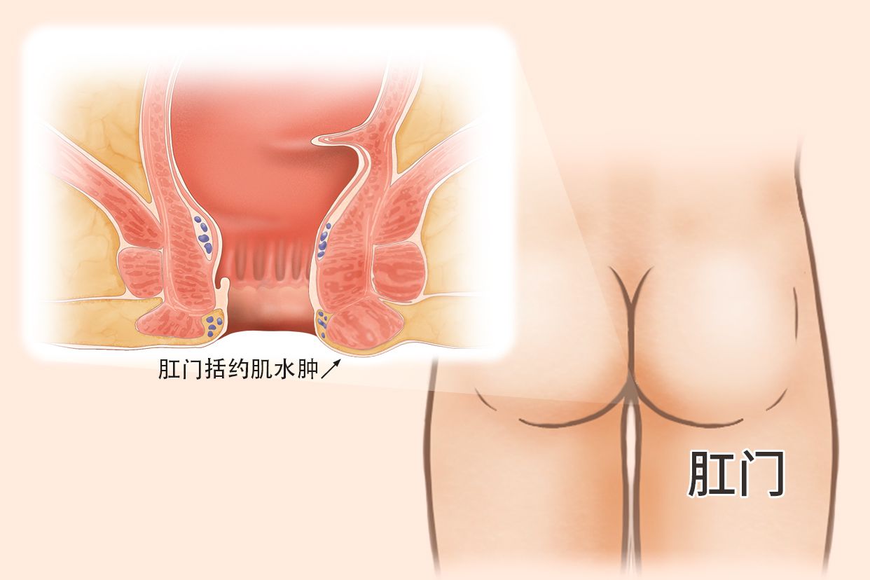 肛门括约肌水肿图片（肛门括约肌水肿疼痛怎么办）