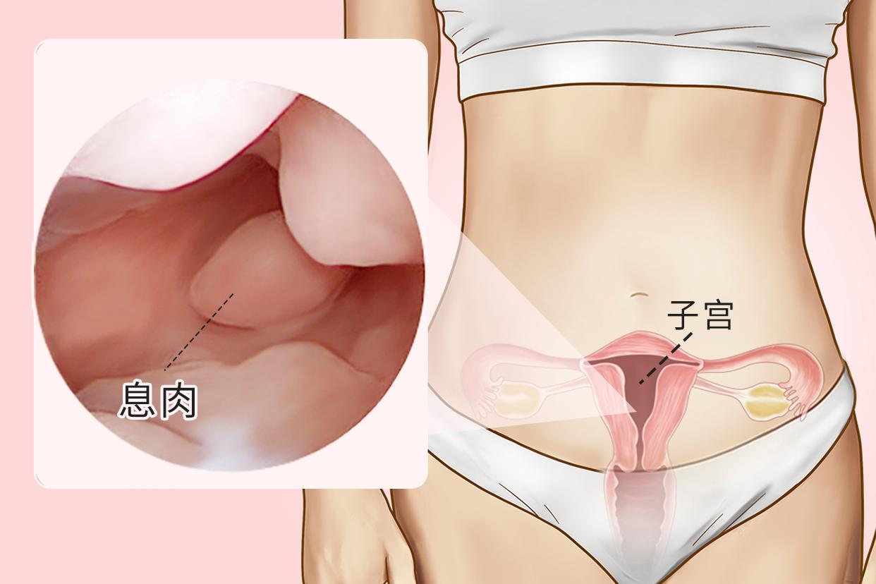 宫腔镜子宫内膜息肉良性图片（宫腔镜检查结果子宫内膜息肉）