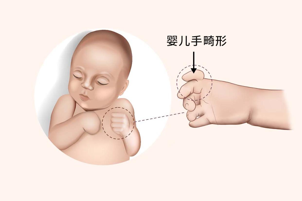 婴儿手畸形图片（婴儿手部畸形矫正）