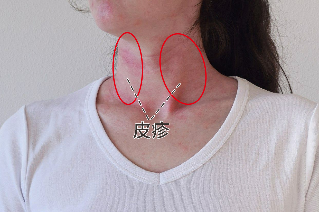 脖子两侧皮疹图片（脖子两侧有皮疹和身体哪个部位有关）