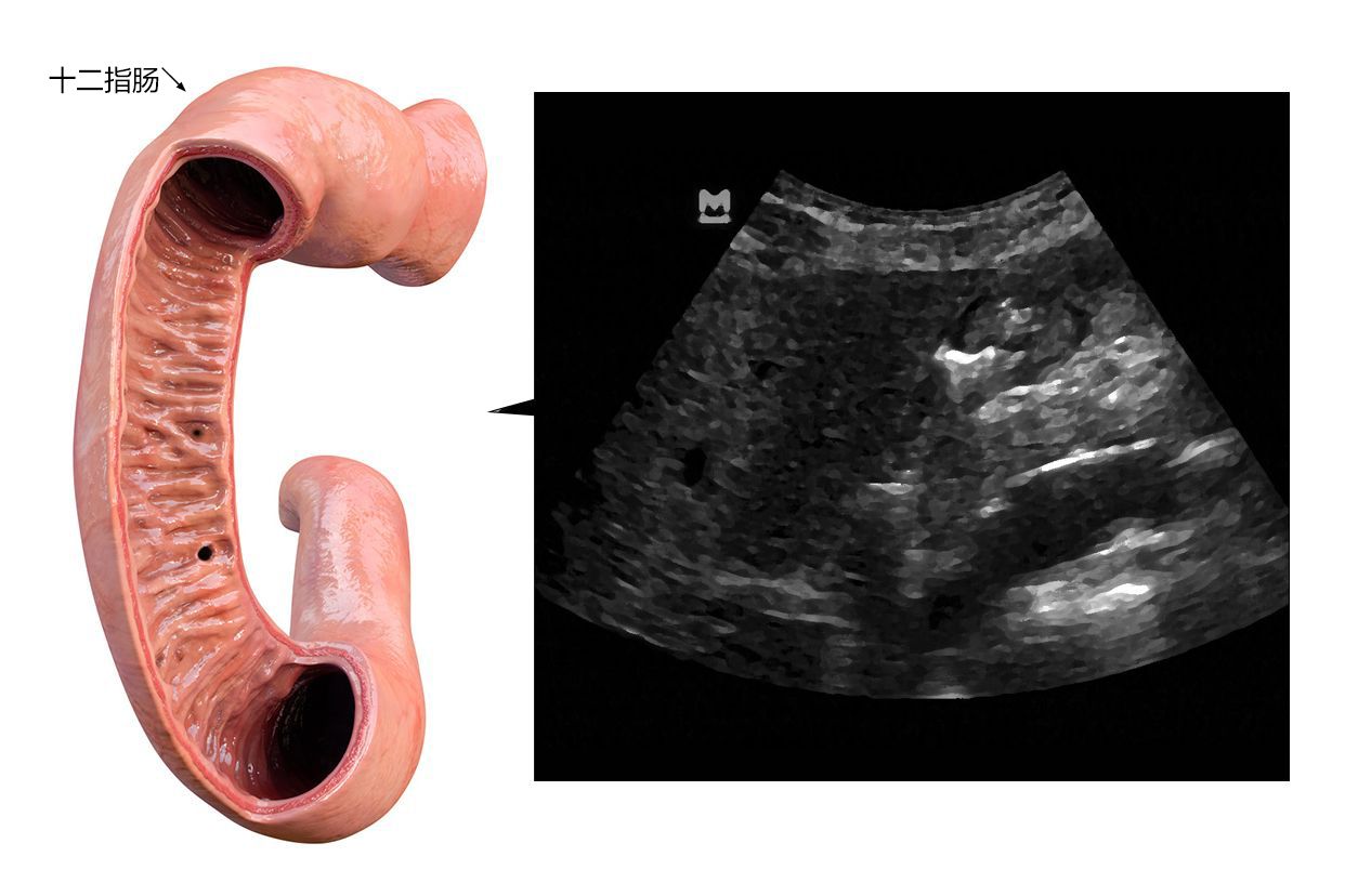 十二指肠超声图像（十二指肠超声造影是什么）