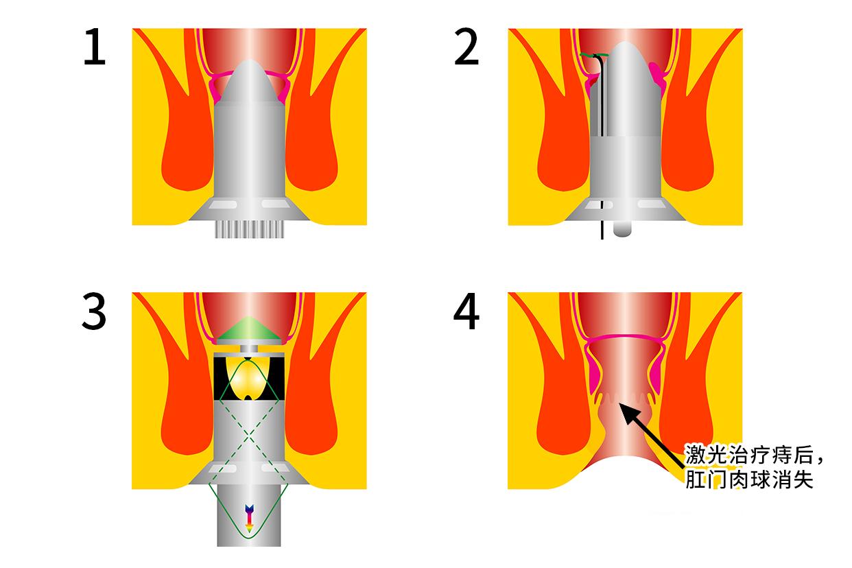 痔疮激光术后肛门口肉球图（痔疮激光手术后有点水肿怎么办）