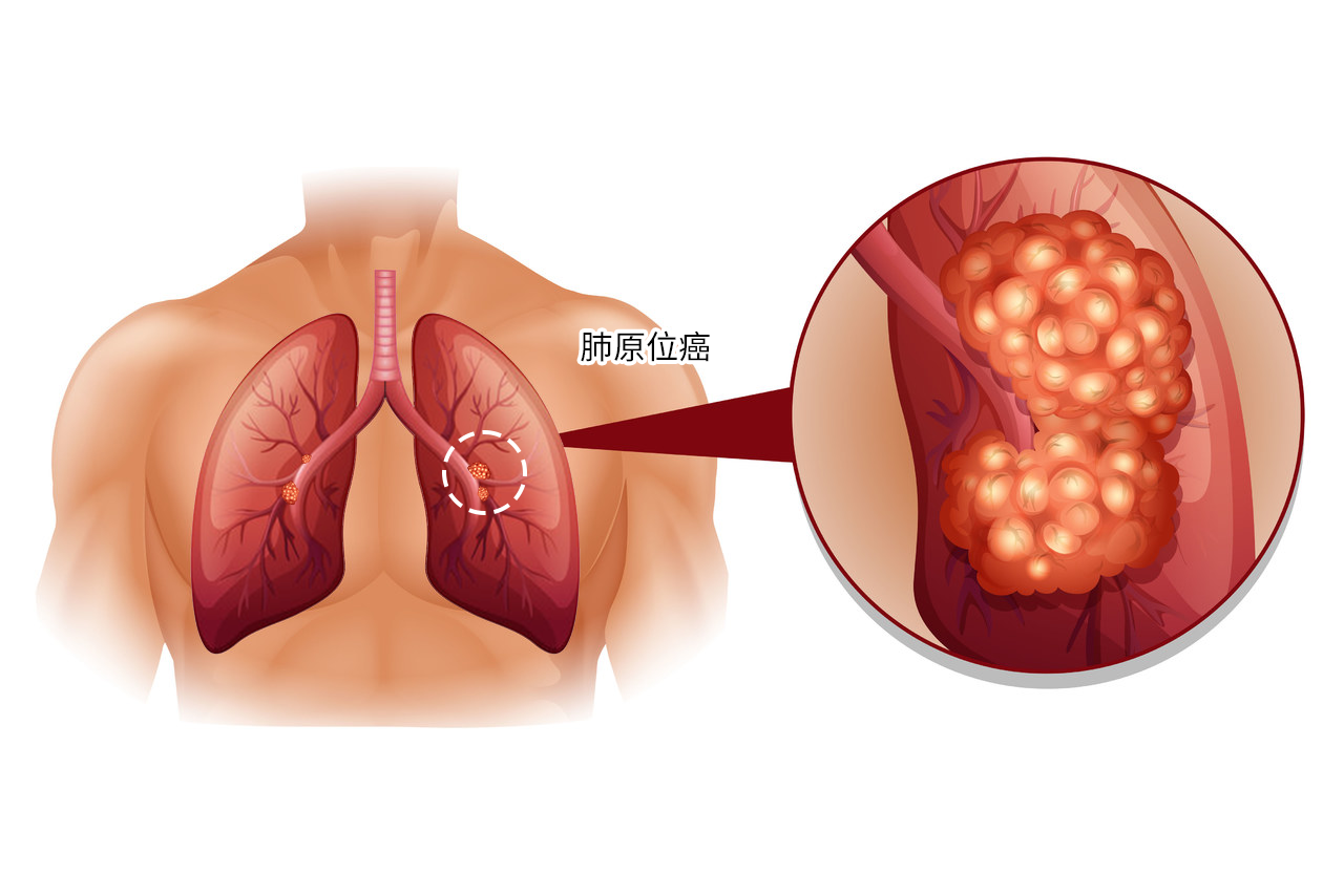 肺原位癌图 肺 原位癌 什么特征